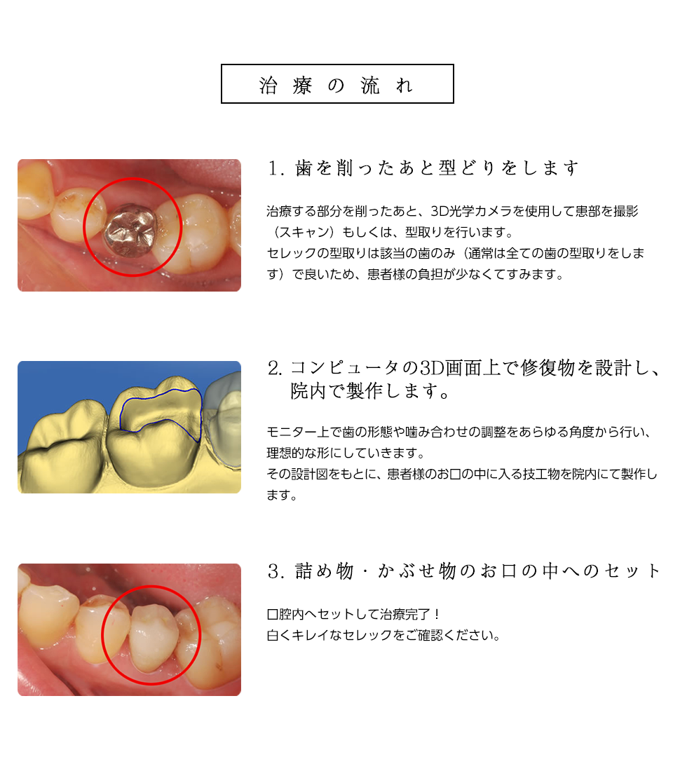 
治療の流れ

1. 歯を削ったあと型どりをします
治療する部分を削ったあと、3D光学カメラを使用して患部を撮影（スキャン）もしくは、型取りを行います。
セレックの型取りは該当の歯のみ（通常は全ての歯の型取りをします）で良いため、患者様の負担が少なくてすみます。

2. コンピュータの3D画面上で修復物を設計し、院内で製作します。
モニター上で歯の形態や噛み合わせの調整をあらゆる角度から行い、理想的な形にしていきます。
その設計図をもとに、患者様のお口の中に入る技工物を院内にて製作します。

3. 詰め物・かぶせ物のお口の中へのセット
口腔内へセットして治療完了！
白くキレイなセレックをご確認ください。

