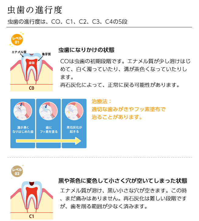 
虫歯の進行度
虫歯の進行度は、CO、C1、C2、C3、C4の5段

レベル01虫歯になりかけの状態
COは虫歯の初期段階です。エナメル質が少し溶けはじめて、白く濁っていたり、溝が茶色くなっていたりします。
再石灰化によって、正常に戻る可能性があります。
治療法：
適切な歯みがきやフッ素塗布で
治ることがあります。

レベル02黒や茶色に変色して小さく穴が空いてしまった状態
エナメル質が溶け、黒い小さな穴が空きます。この時、まだ痛みはありません。再石灰化は難しい段階ですが、歯を削る範囲が少なく済みます。
治療法：
虫歯に冒された部分を削り、レジン（歯科用プラスチック）を詰めて治療します。

レベル03虫歯が象牙質まで進行した状態
象牙質まで虫歯が進行した状態です。象牙質は柔らかく急激に虫歯が進行するので、早急に治療をした方が良いでしょう。ここまでくると、冷たいものや甘いものがしみたりします。
治療法：虫歯に冒された部分を削り、インレー（詰め物）やレジン（歯科用プラスチック）で補います。

レベル04虫歯が歯髄にまで達し激痛を伴う状態
歯の神経（歯髄）まで虫歯が進行した状態です。
神経に炎症が起きるので、ズキズキとひどく痛みを感じます。
治療法：神経を除去し、神経が入っていた管（根管）の内部を消毒して薬剤を詰める根管治療を行い、クラウン（被せ物）を被せます。

レベル05歯冠部まで溶けてしまった末期の状態
歯の上部が溶けてしまい、ほとんど根だけ残った状態です。更に炎症が進行すると、神経が死に、痛みがなくなります。この段階までくると、抜歯しか方法がないことが多いです。
治療法：
多くの場合、抜歯が必要です。抜歯後、入れ歯やインプラントなどで失った歯の機能の回復を図ります。


